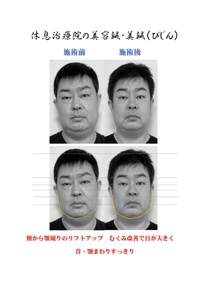 休息治療院の美容鍼を受けた４０代男性