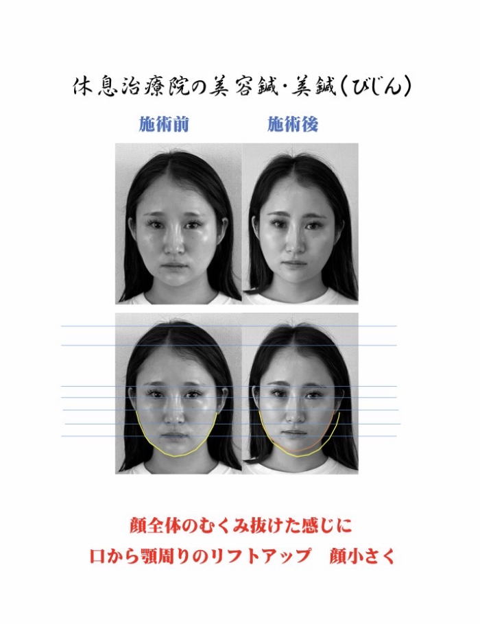 美容鍼を３回受けた３０代前半女性