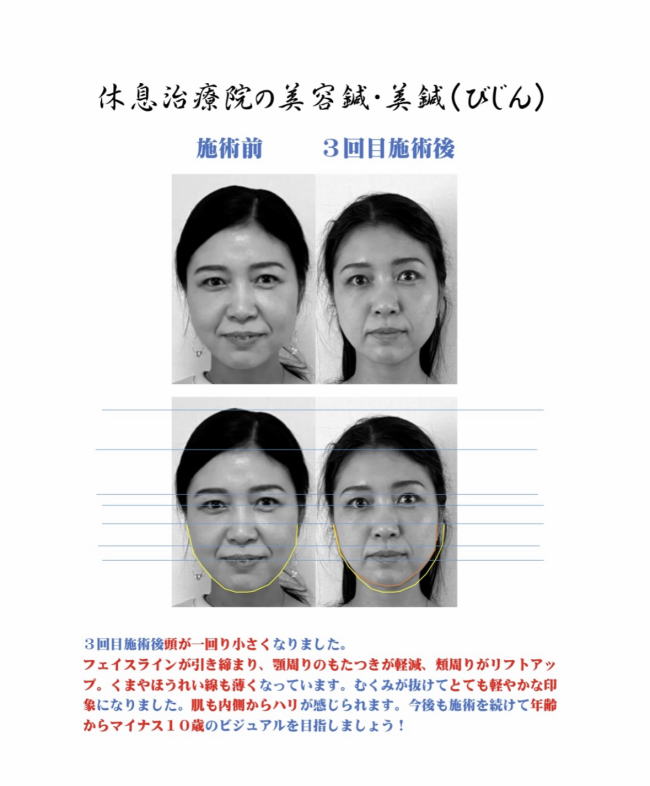 名古屋の休息治療院の美容鍼を受けた４０代女性