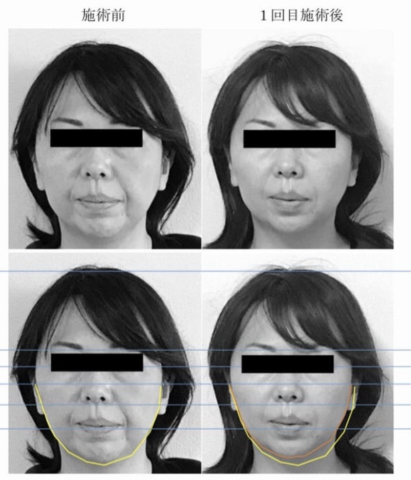 名古屋の美容鍼によるほうれい線改善症例４０代女性正面比較