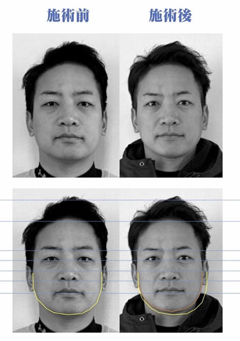 名古屋で美容鍼を受けた30代の口周りたるみ改善症例