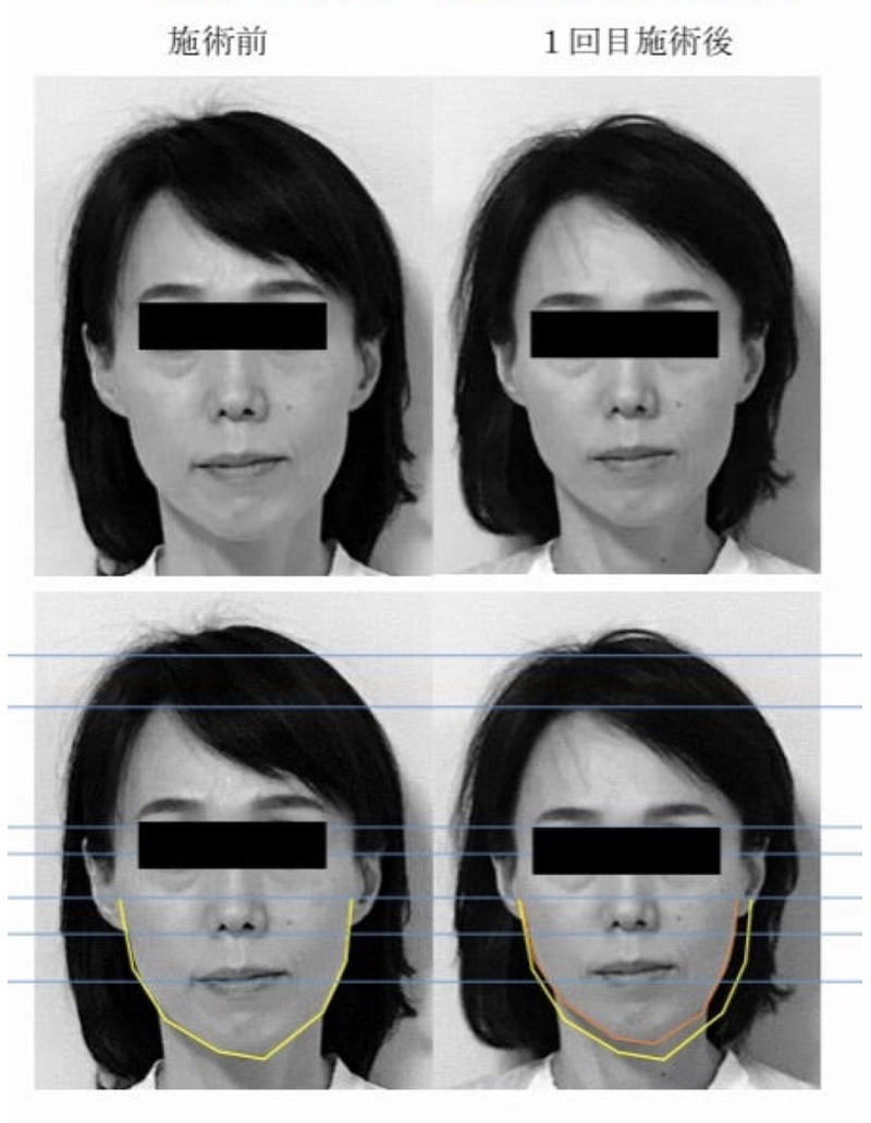名古屋の美容鍼による50代女性のたるみ改善ビフォーアフター写真