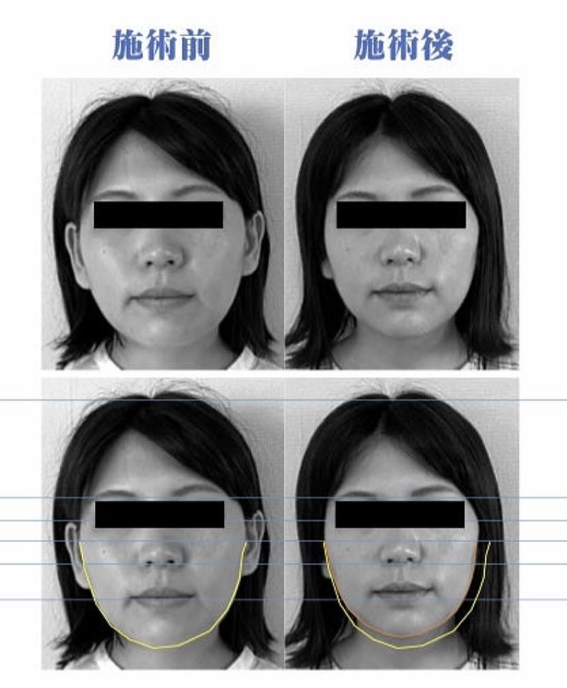 名古屋の休息治療院で美容鍼を受けた女性のむくみ改善例。施術前後で頬とフェイスラインが引き締まった比較写真