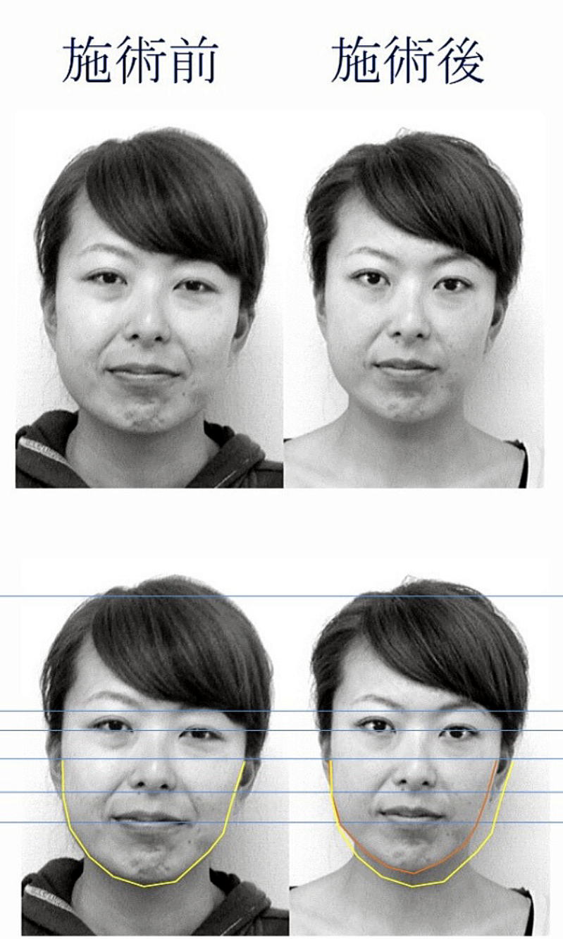 名古屋の休息治療院で美容鍼を受けた30代女性の顔のむくみ改善症例。施術前後でフェイスラインがすっきりした比較写真